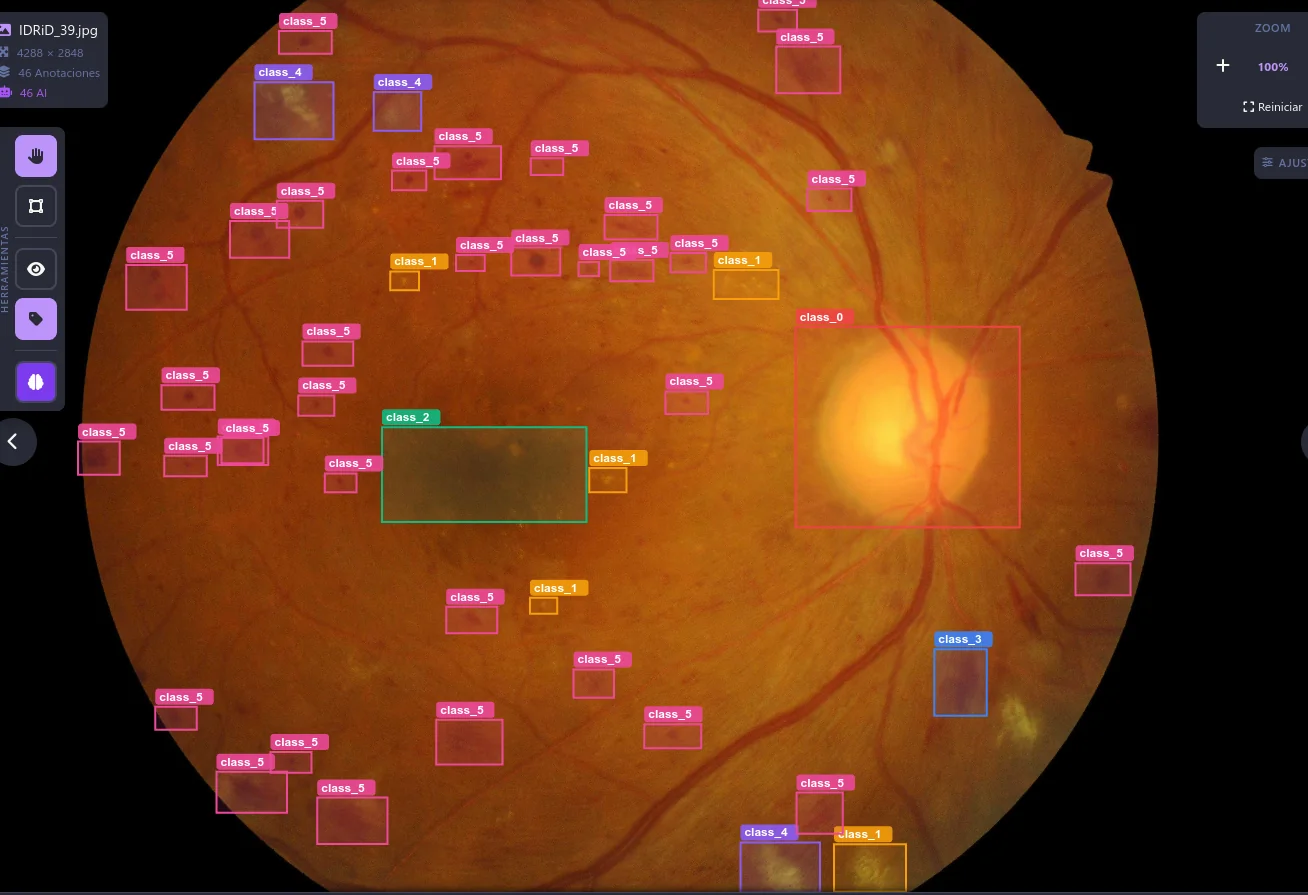 Detección de lesiones sobre retinografía
